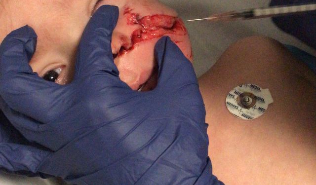 Ankara'da pitbull saldırısına uğrayan 1,5 ve 5 yaşındaki kardeşler yaralandı